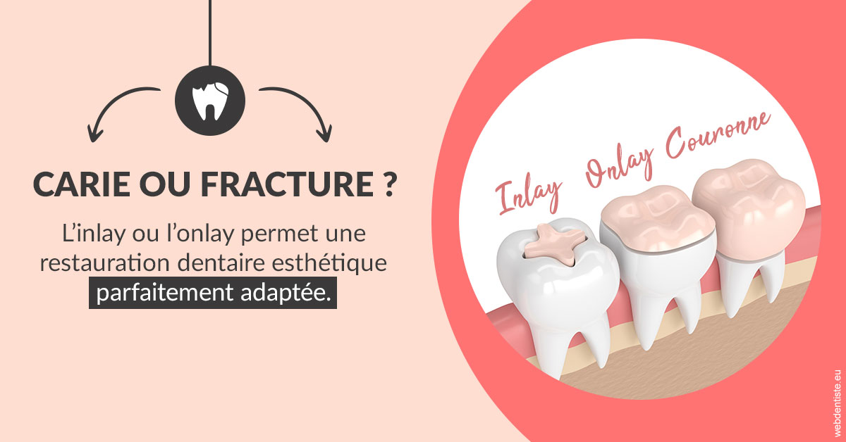 https://www.wilm-dentiste.fr/T2 2023 - Carie ou fracture 2