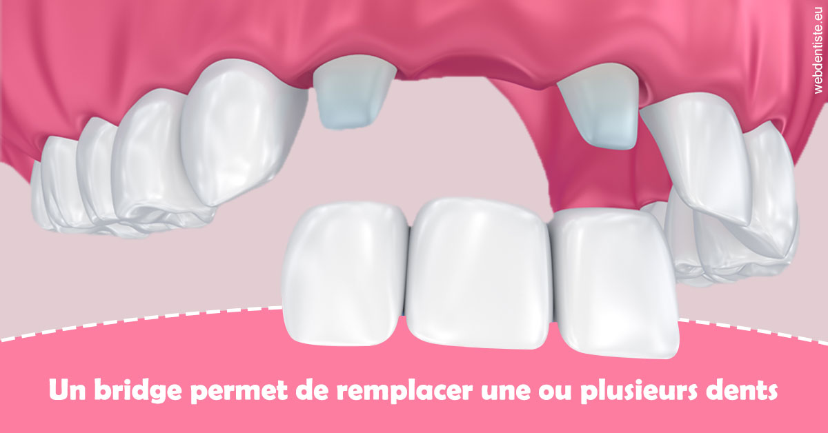 https://www.wilm-dentiste.fr/Bridge remplacer dents 2