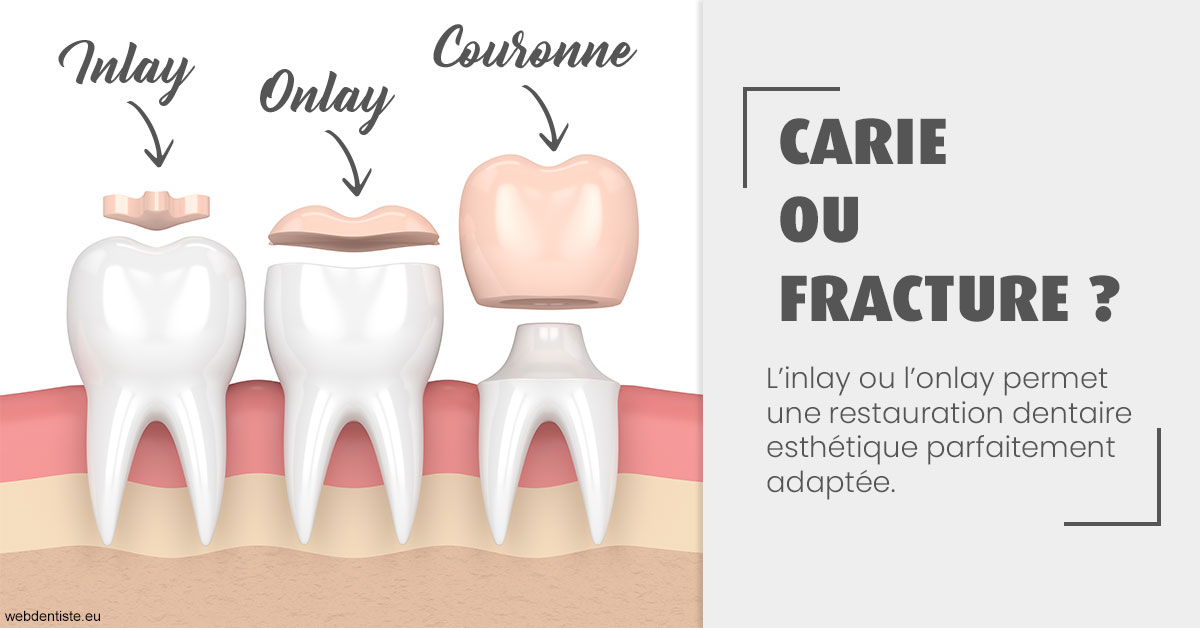 https://www.wilm-dentiste.fr/T2 2023 - Carie ou fracture 1