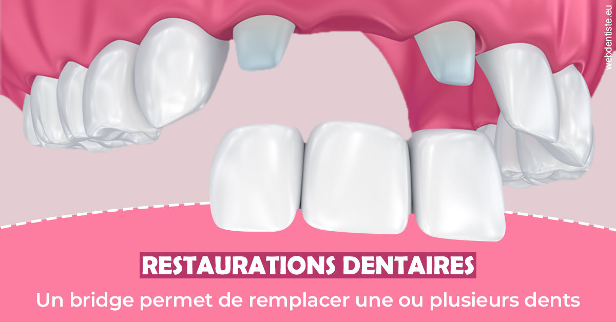 https://www.wilm-dentiste.fr/Bridge remplacer dents 2