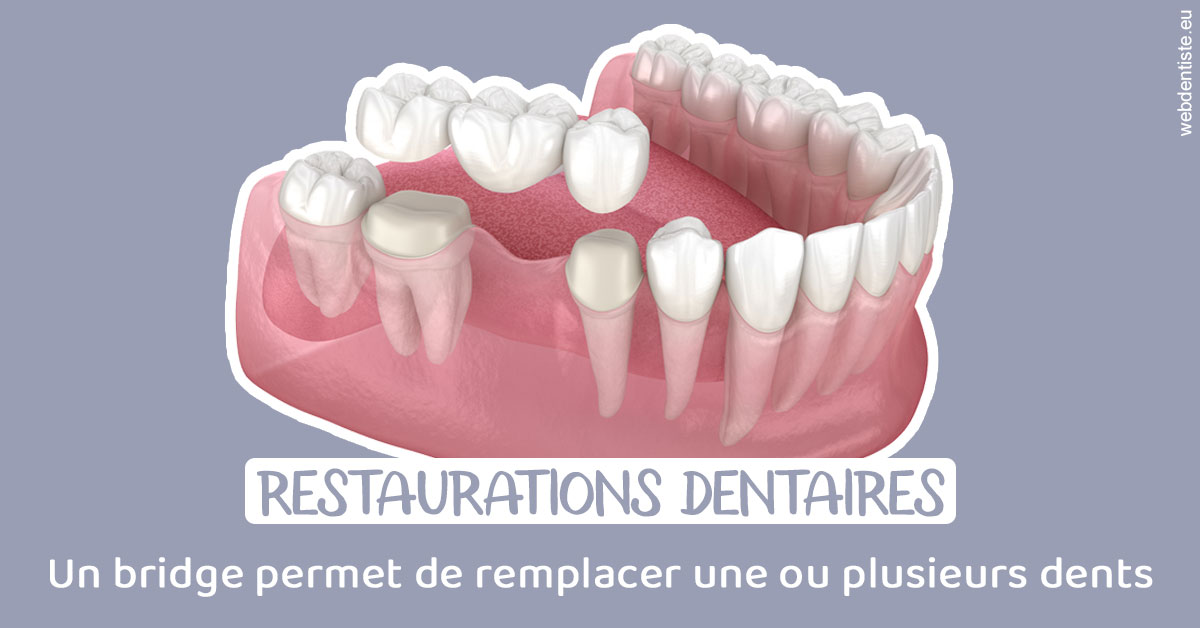 https://www.wilm-dentiste.fr/Bridge remplacer dents 1
