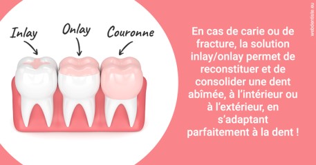 https://www.wilm-dentiste.fr/L'INLAY ou l'ONLAY 2